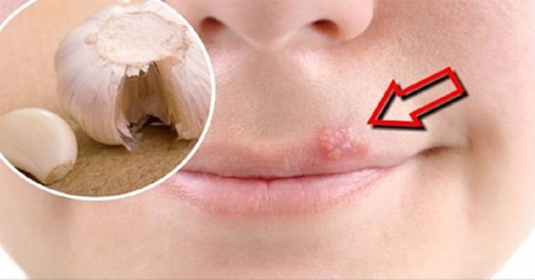 7 Home Remedies For Lip Infection